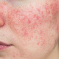 Understanding Rosacea: Symptoms, Types, Treatment, and What Happens If Left Untreated